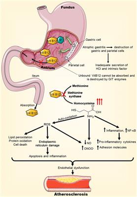 Infection with Helicobacter pylori may predispose to atherosclerosis: role of inflammation and thickening of intima-media of carotid arteries